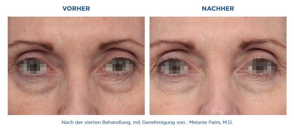 Augen