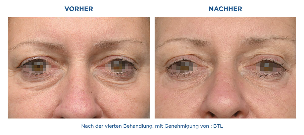 Augen