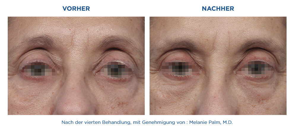 Augen